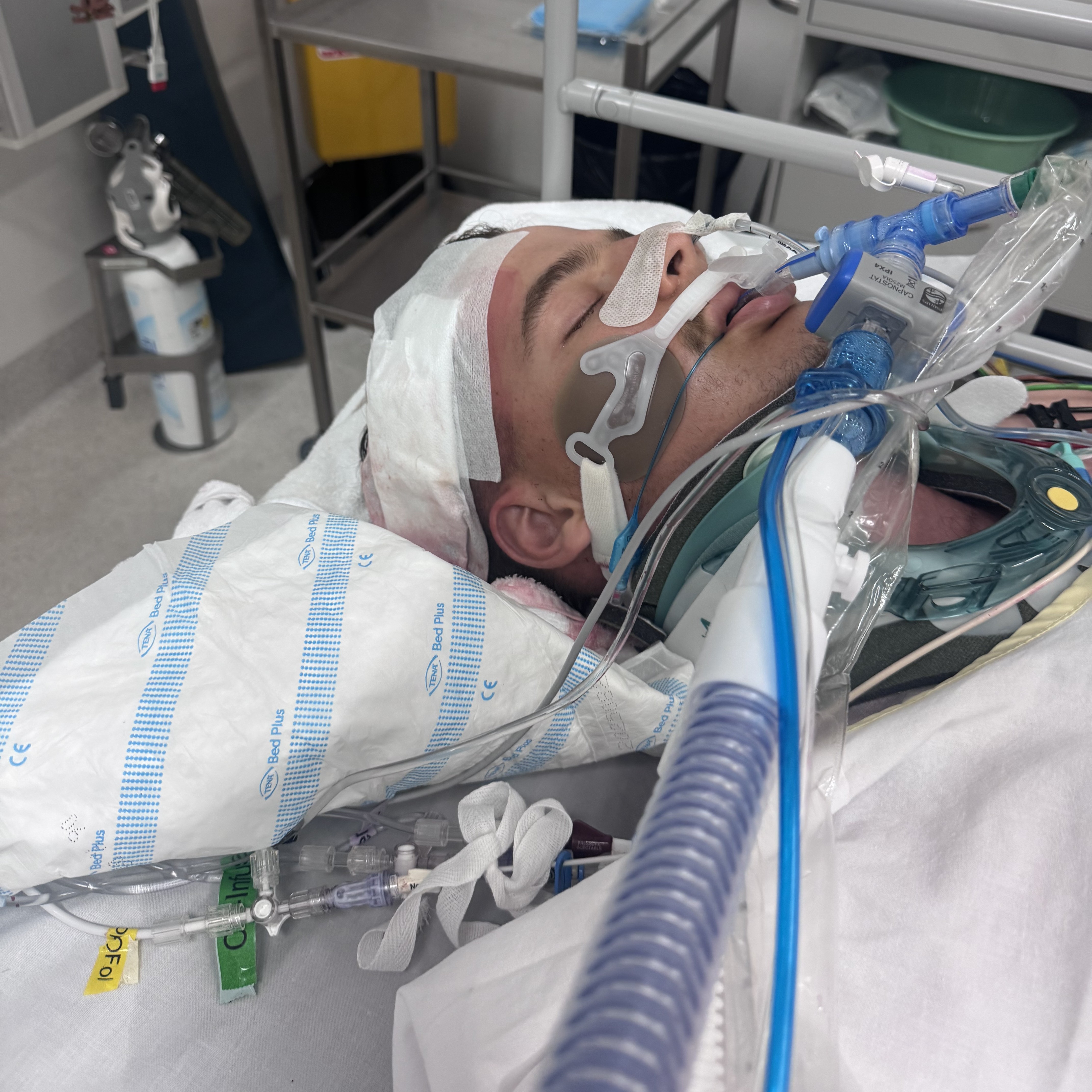 An unconscious man laying in a hospital bed with medical equipment around his face.